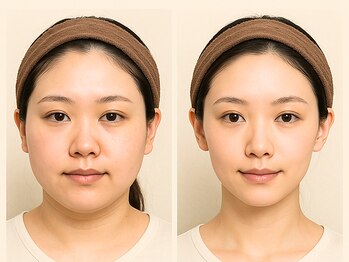オリエンタルローザ 表参道(Oriental Rosa)の写真/最上位インディバER200[インディバフェイシャル 75分]幹細胞増殖×リフトUP！お顔～ヘッドケアまで¥9800★