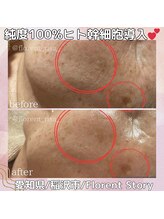 アーキ(ARCHI)/ヒト幹細胞導入エステ