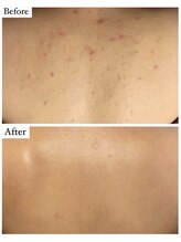 ベル 恵比寿(Belle)/背中のREVIハーブピーリング