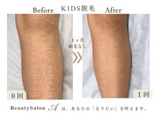エース(A)の雰囲気（お肌にやさしく！しっかり効くのに痛み最小限◎）