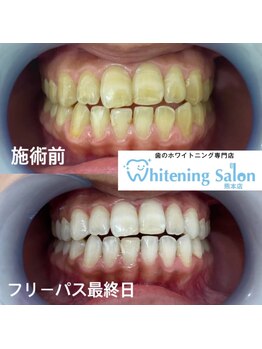 ホワイトニングサロン 熊本店/【ホワイトニング施術例】