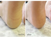 トレデュール 長町南店(Tre's dur)/足裏角質ケア☆