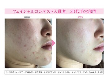 エヴァーグレース 栄店/SNSで話題ハイドラフェイシャル