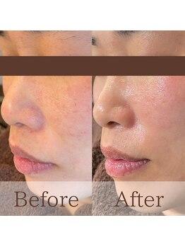 凪眠/小顔リンパフェイシャルの効果20