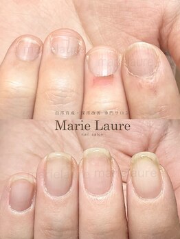 マリーロール 淀屋橋本店(Marie Laure)/自爪育成/深爪矯正/ネイルケア