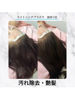 エクラ 六本木(eclat)/プラズマスカルプ