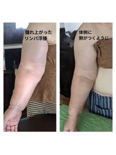 紬(TSUMUGI)/リンパの腫れ上がりも諦めない