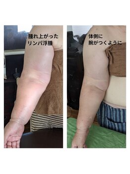 紬(TSUMUGI)/リンパの腫れ上がりも諦めない