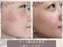 整骨院トリデ(整骨院TORIDE)/赤み、ニキビ