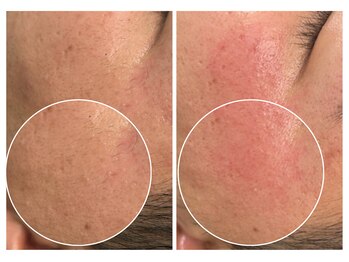 タイディ(TIDY)/メンズフェイシャルワックス