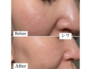 レーヌ(Reine)/白玉ピコジェット＋臍帯原液導入