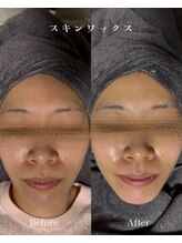 ミレラ(Mirela)/スキンワックス1回