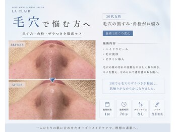 ラ クレール ビューティーサロン(LA CLAIR)の写真/毛穴の黒ずみはLA CLAIR beauty salonにお任せ♪信頼の技術でお肌のキメを整えワントーン明るく化粧ノリUP!