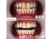 ルブラン 奈良店(Le Blanc)/歯が黄ばみやすい人の特徴