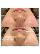 エミュ(e'mu)/赤み改善！肌も唇もプルプル♪