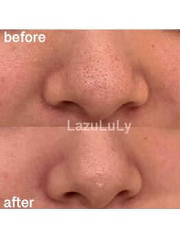 ラズリ(LazuLuLy)/毛穴汚れお任せください！