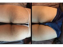 美尻研究所 麻布十番店/痛かったお尻ぶつぶつが減少