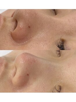 ユミサロン(U Mi Salon)/頑固な鼻の黒ずみすっきりクリア