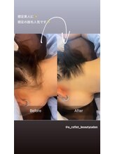 ア ルフレ(A.reflet)/脱毛