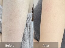 シェリル 松江店(CHARIRE)/ハーブピーリング/毛孔性苔癬