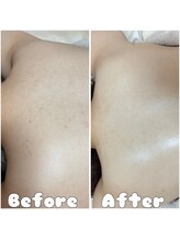 グラシア 倉敷店(Gracia)/REVIハーブピーリング