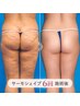 【垂れ尻卒業!】サーモシェイプ痩身で憧れの桃尻へ◎セルライト/ヒップアップ