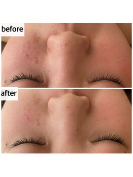 メナードフェイシャルサロン 岐阜茜部/ホワイトニングパック