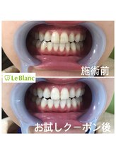 ルブラン 奈良店(Le Blanc)/初回の2回でなんと！！！