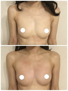 デミーナ(Demyna)/【バストアップ】症例 育乳