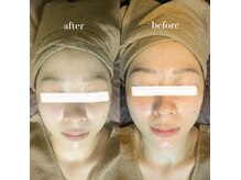 パルフェ(Parfait)/ハーブピーリング 