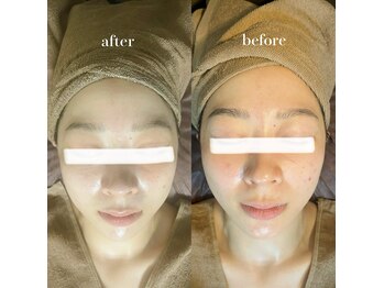 パルフェ(Parfait)/ハーブピーリング 