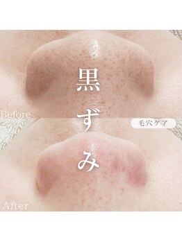 オーキッド(ORCHID)/毛穴ケア♪