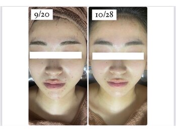 ホワイトアクア 四日市店(WHITE AQUA)/ニキビケア/四日市ハーブ