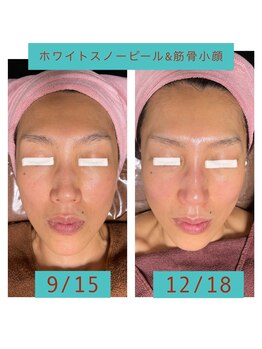 ココ 2号店(CoCo)/ホワイトスノー＆筋骨小顔