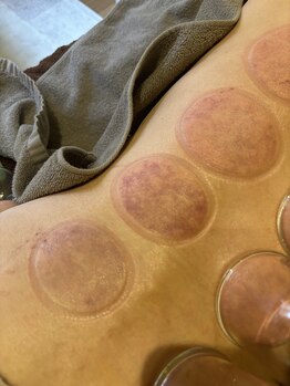 ニカ(Nica)/【吸い玉でお身体をチェック】