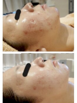 エン(O'en)/エクソソーム＋幹細胞導入♪