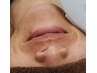 男女【顔脱毛】1回　顔全台脱毛 (眉、鼻、口周り、おでこ、うなじ)　美肌効果