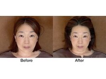 こじま 富雄団地接骨院/目の下のたるみ