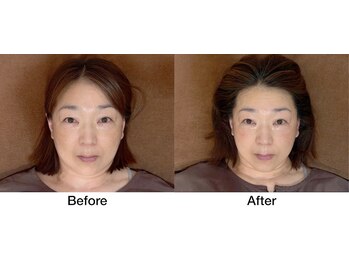 こじま 富雄団地接骨院/目の下のたるみ