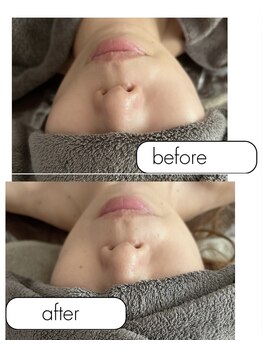 ミィ(miii)/小顔角質ケア付きマッサージ