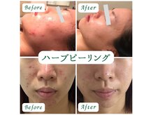 選べる2種類の国産ハーブピーリング。美容鍼と一緒に施術可能