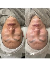 サロンエル(SALON el)/◇肌質改善ピーリング◇