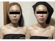 エスポワール(espoir)/小顔コルギ