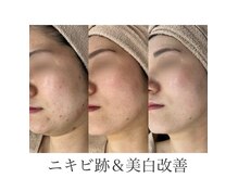 アルフォービューティー 広島店(ALU for beauty)の雰囲気（全国クリスティーナ取扱実績全国1位◎各種ピーリング取り揃え）