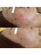 プリュムアイ フェイシャルホーム(prume eye.facial home)の写真/肌細胞にアプローチ。自然由来のハーブで根本ケア！しつこい繰り返すニキビに◎