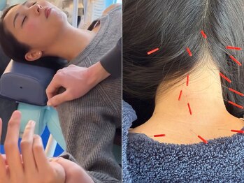 アオヤマ サロン ワイゼット(AOYAMA SALON YZ)の写真/【マッサージでは物足りない首肩こりに】深いコリを狙う鍼灸×整体|施術歴20年以上