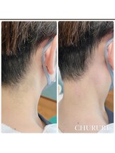 チュルリ 新町店(Chururi)/うなじ/うなじワックス脱毛/脱毛
