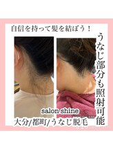サロンシャイン(Salon Shine)/うなじ脱毛２０代後半女性