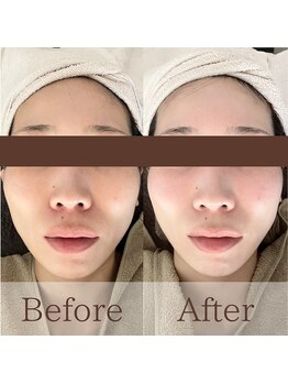 凪眠/小顔リンパフェイシャルの効果28