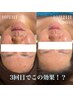 肌質改善　肌荒れでお悩みの方限定＋選べるオプション 2個付
